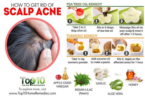 Scalp Acne Treatment