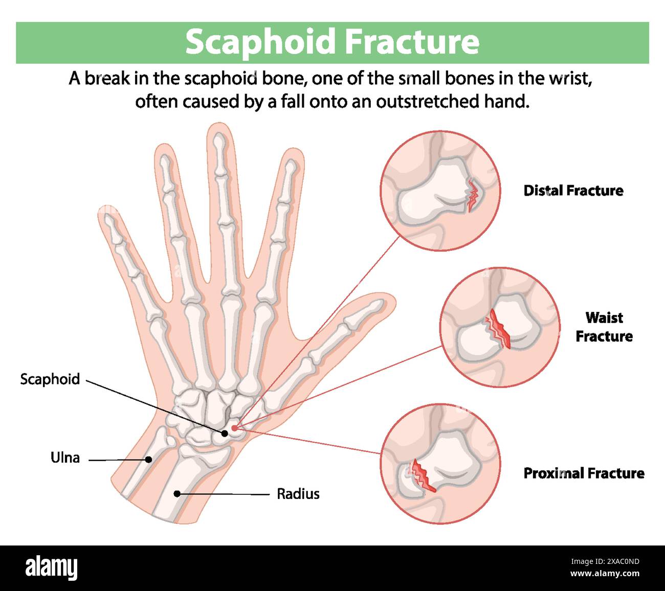 Scaphoid Bone Fracture