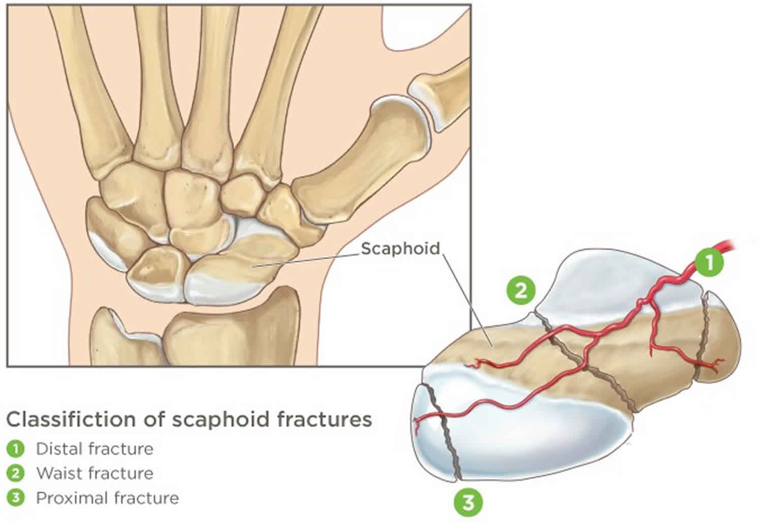 Scaphoid Fracture Treatment