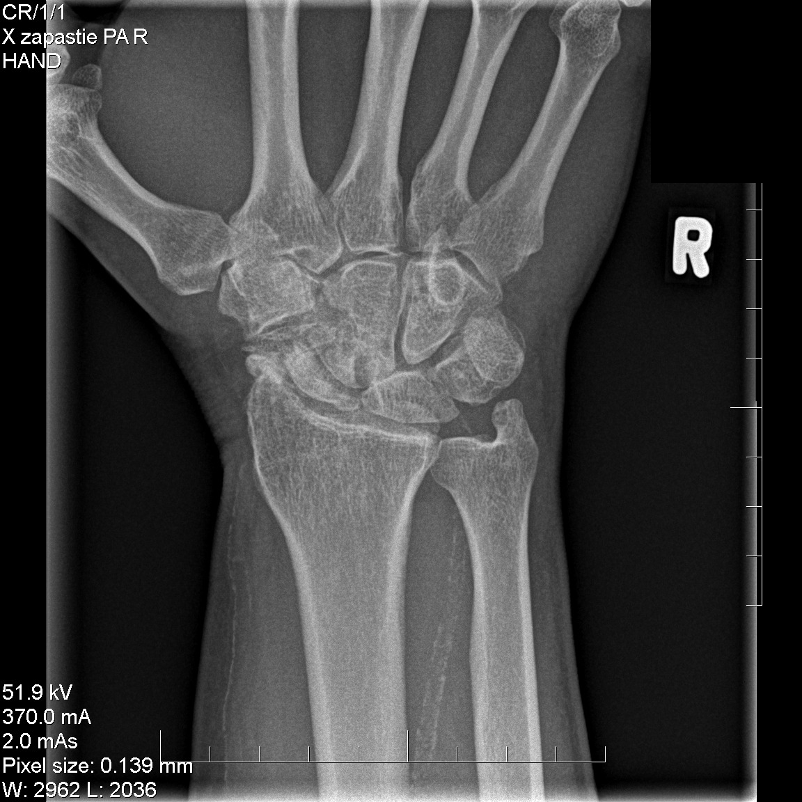 Scaphoid Nonunion Advanced Collapse