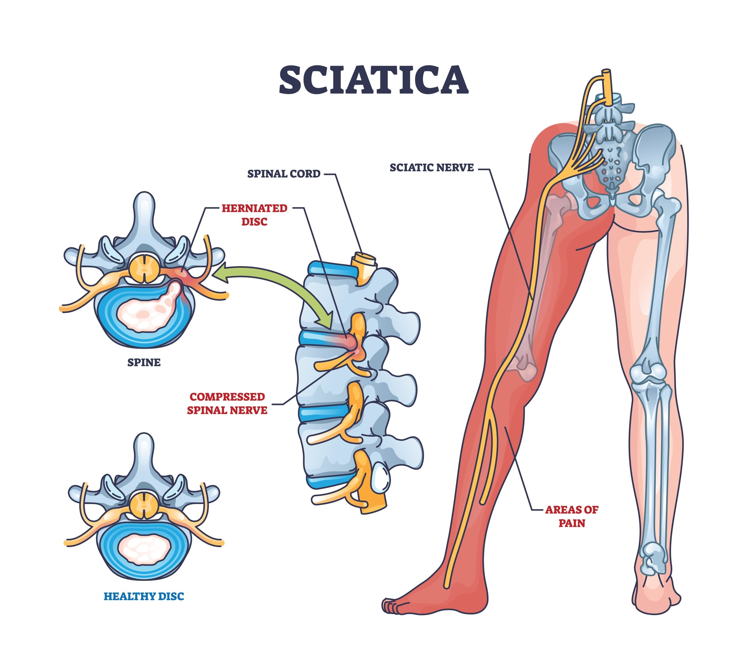 Sciatica Medical Procedure