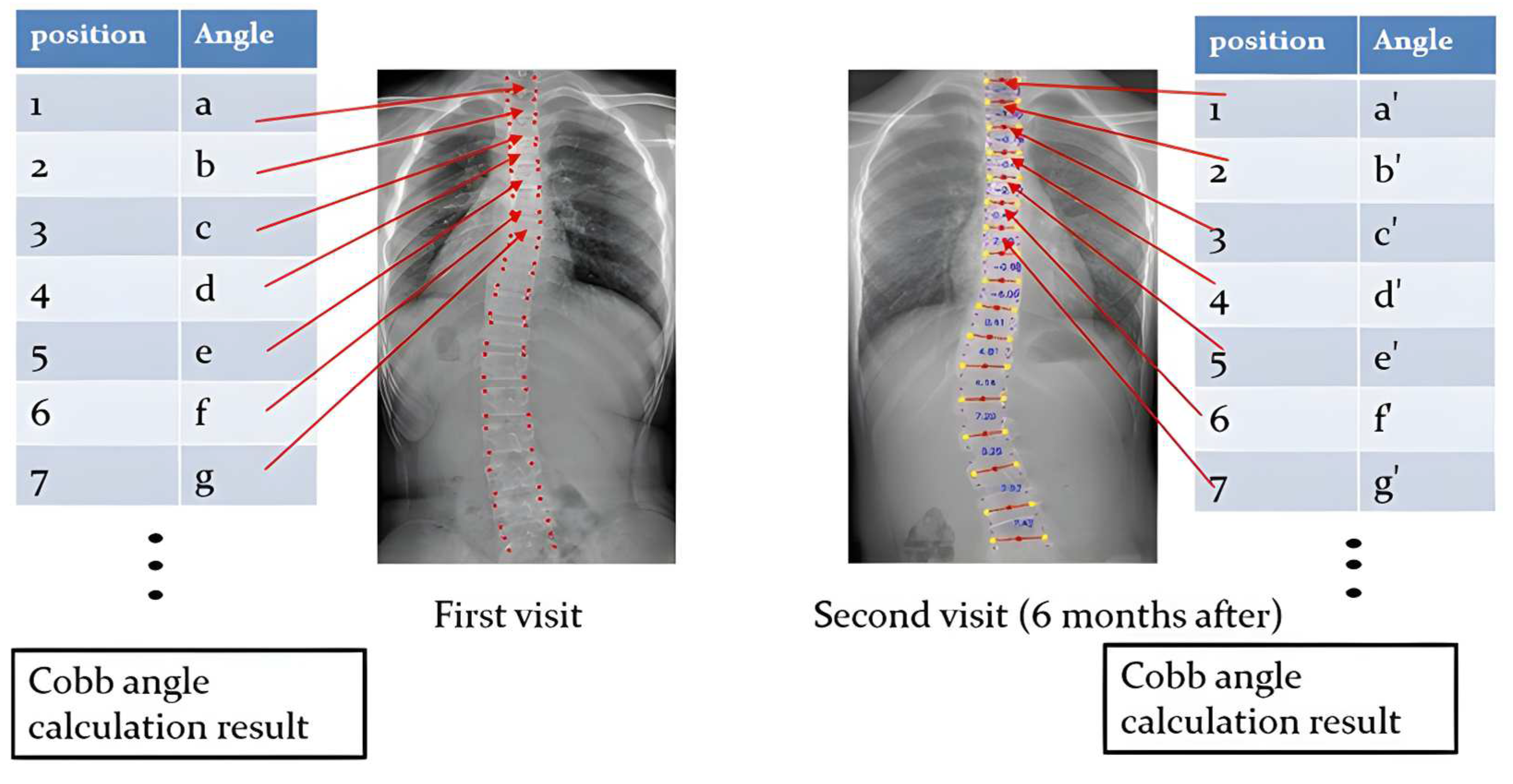 Scoliosis Cobb Angle