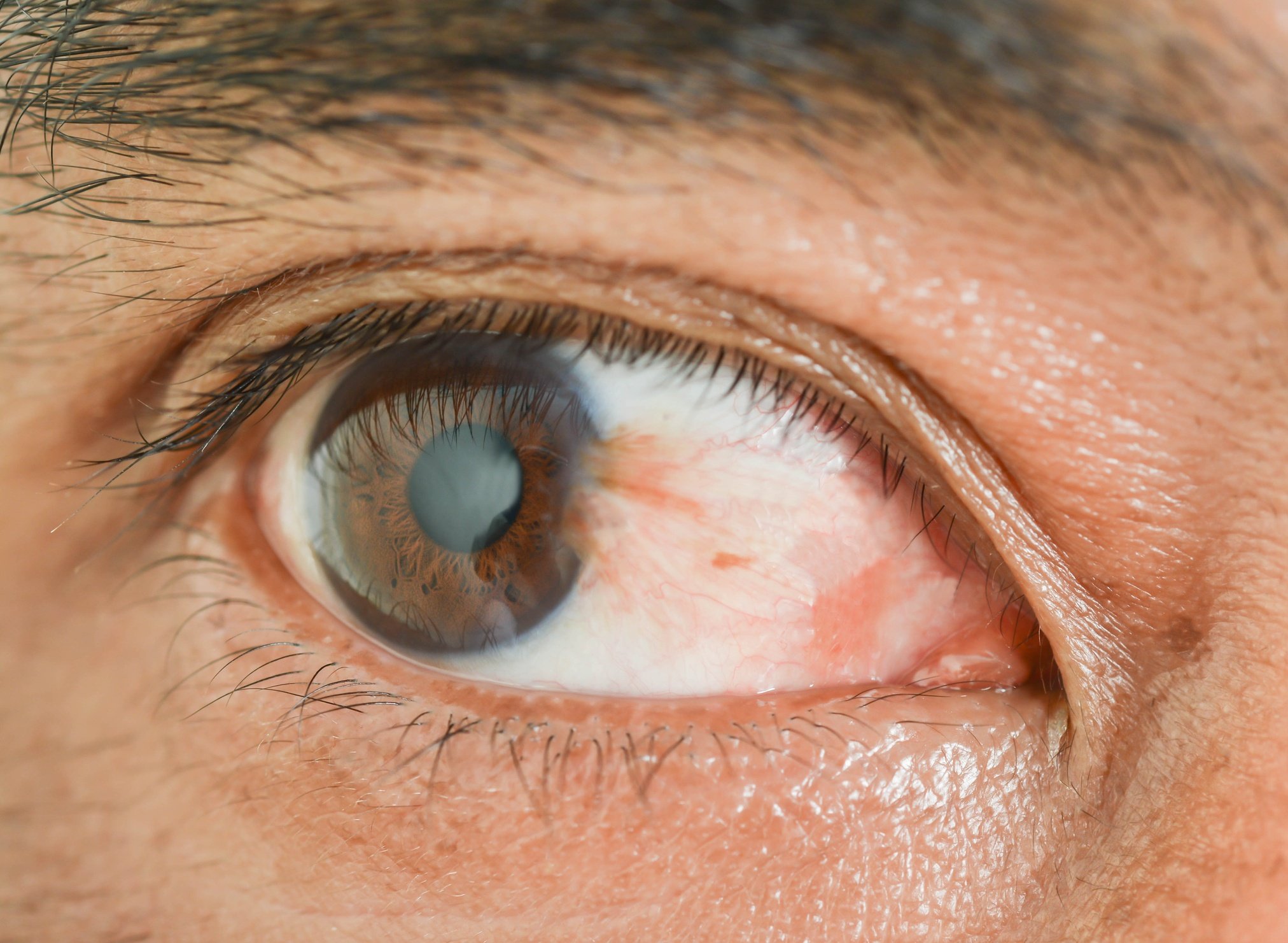 Scratched Cornea Symptoms