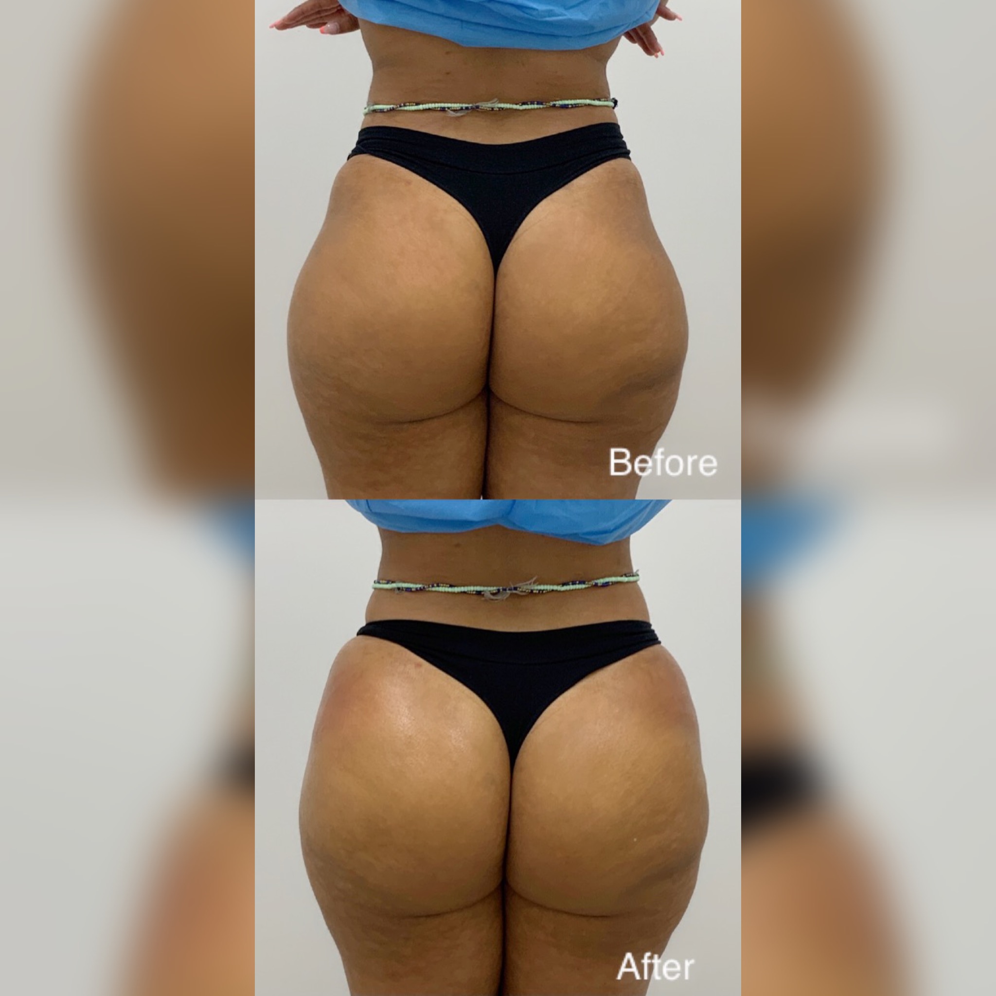 Sculptra Butt Injections
