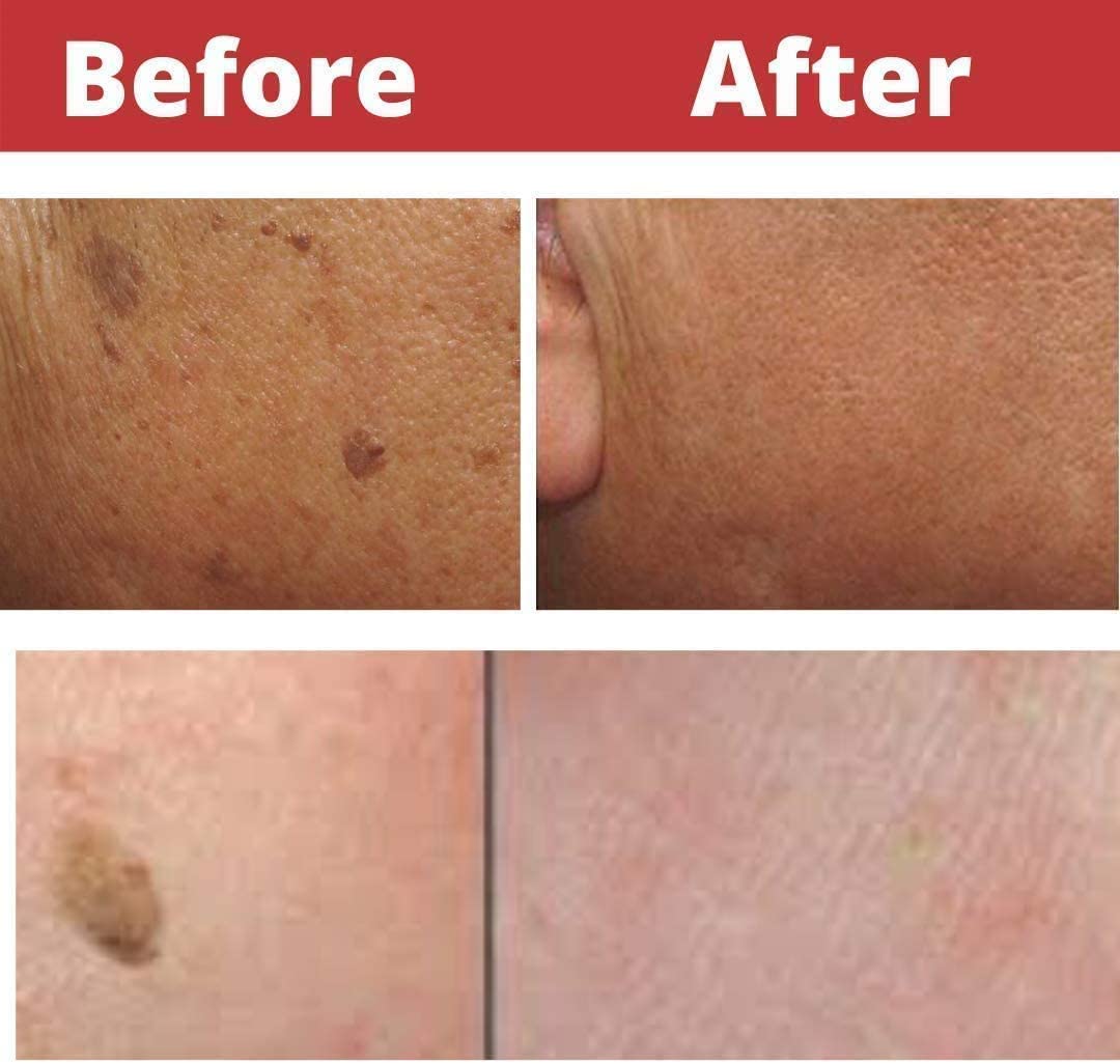 Seborrheic Keratosis Removal At Home
