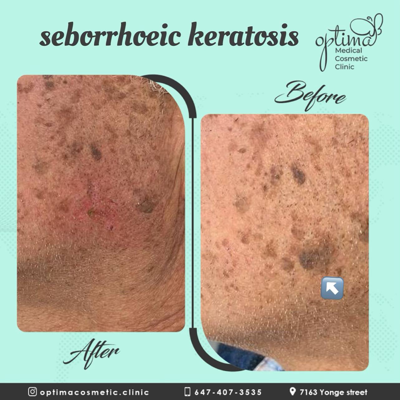 Seborrheic Keratosis Treatment