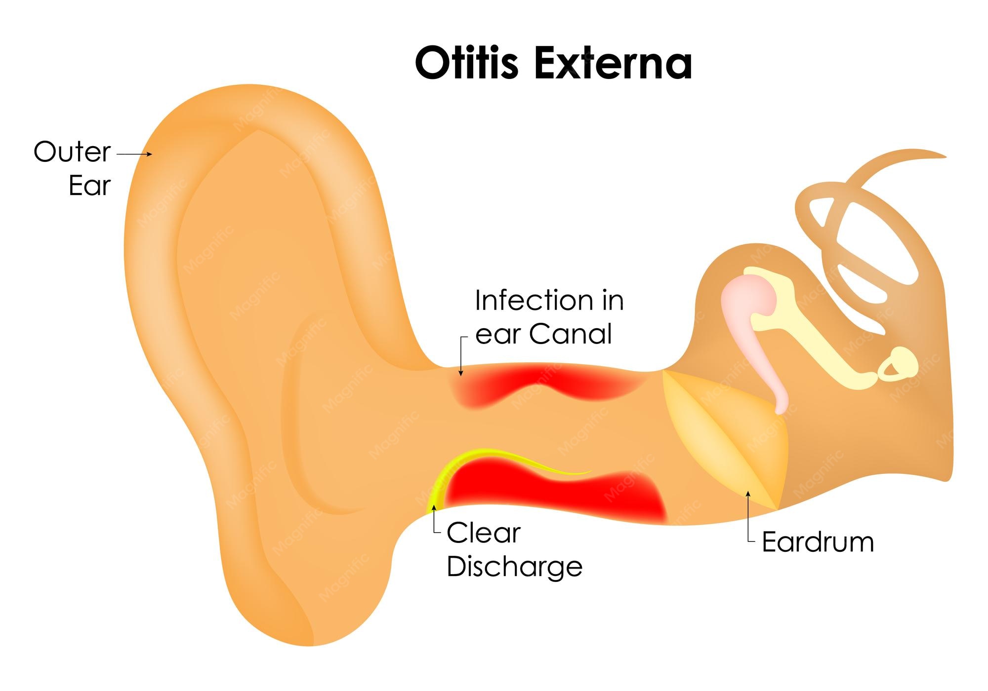 Secretion From Ear