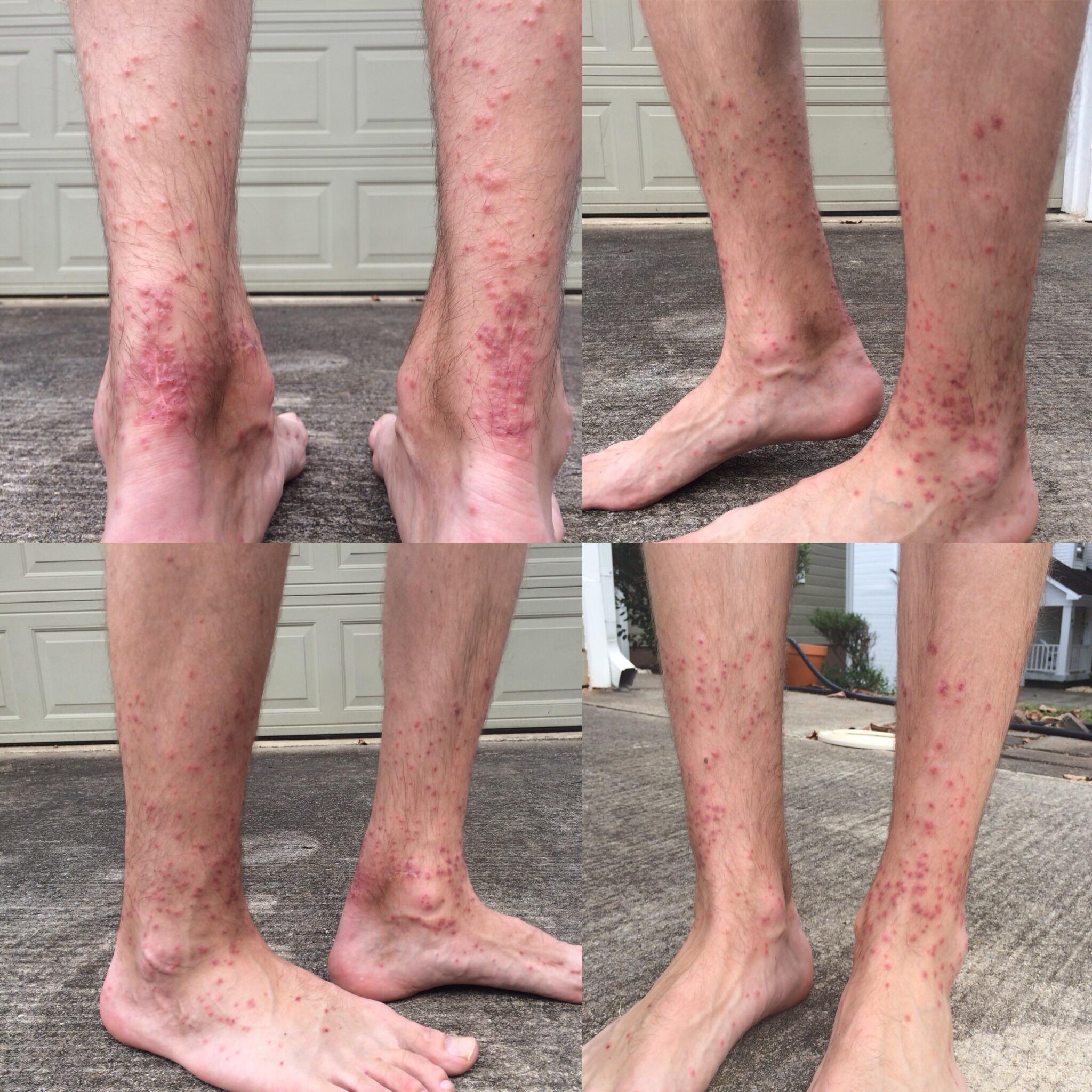 Seed Tick Bites