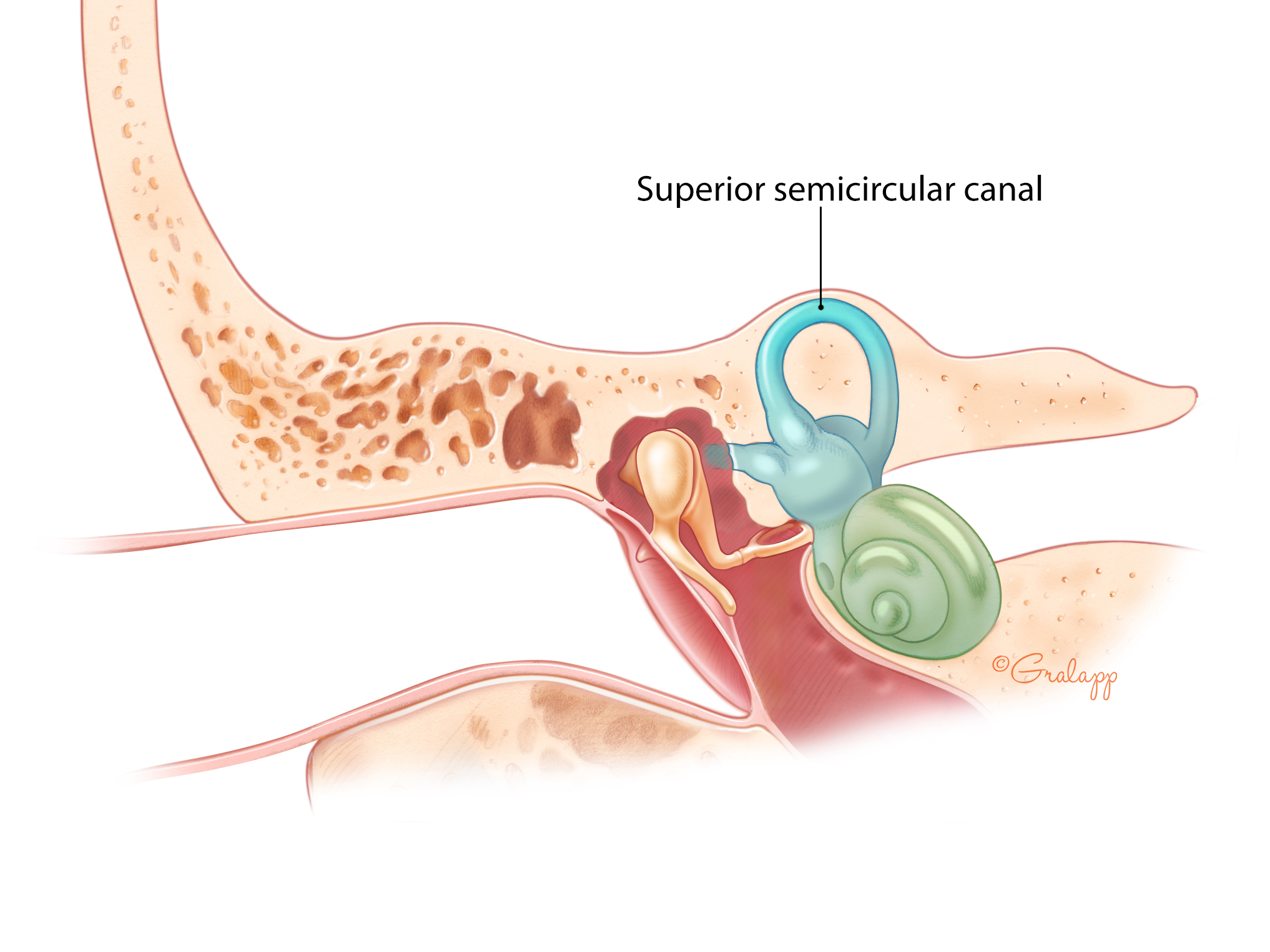 Semicircular Canal Dehiscence