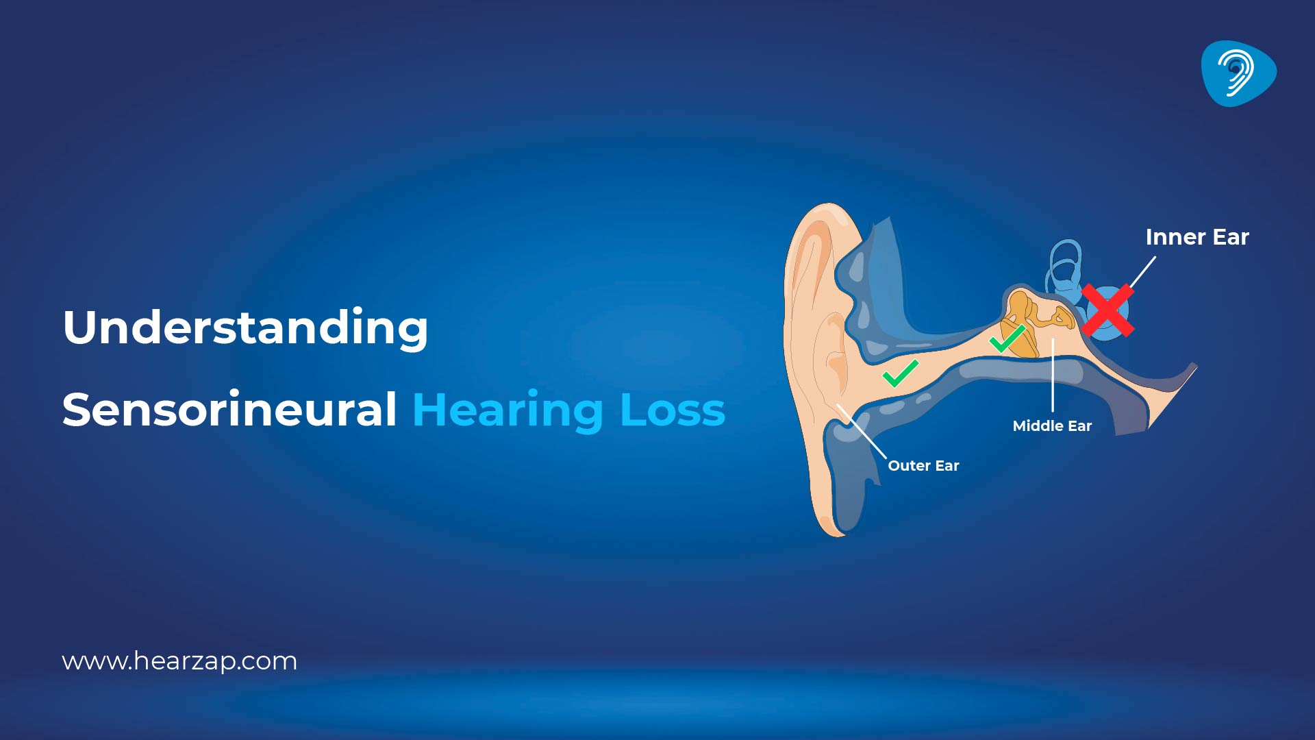 Sensorineural Hearing Loss Symptoms