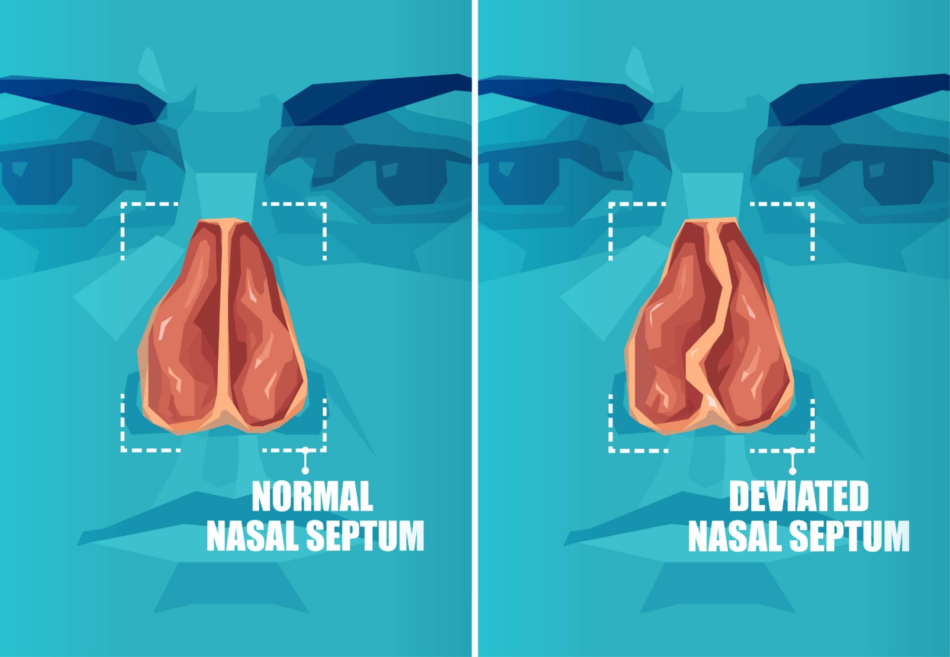 Septorhinoplasty For Deviated Septum