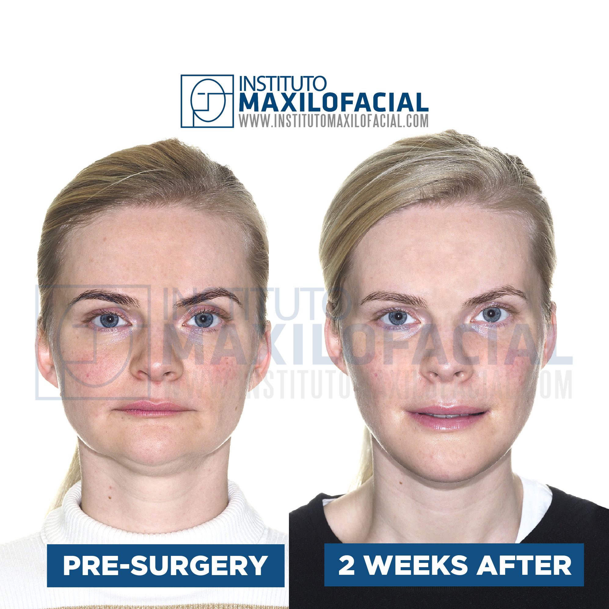 Short Face Syndrome Surgery