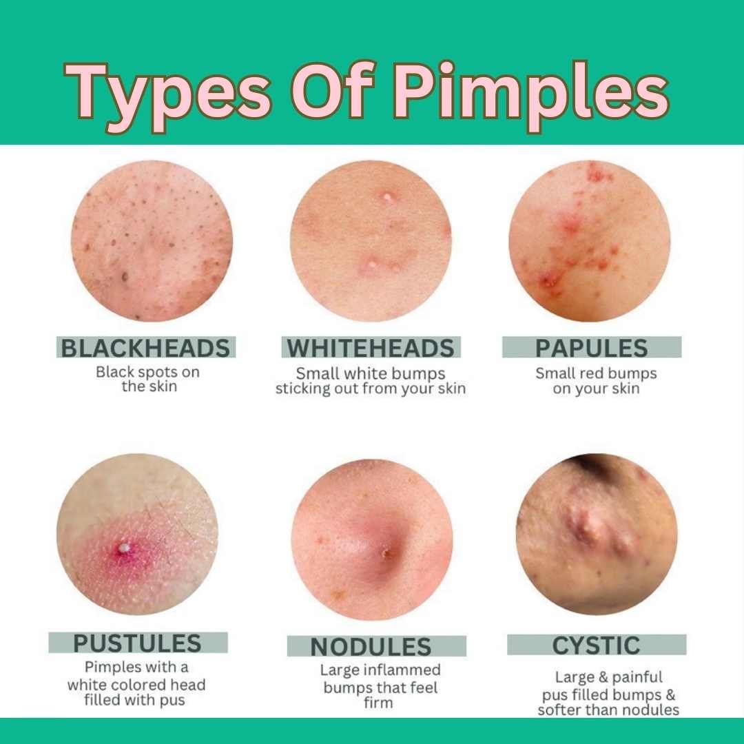 Should U Pop Pimples