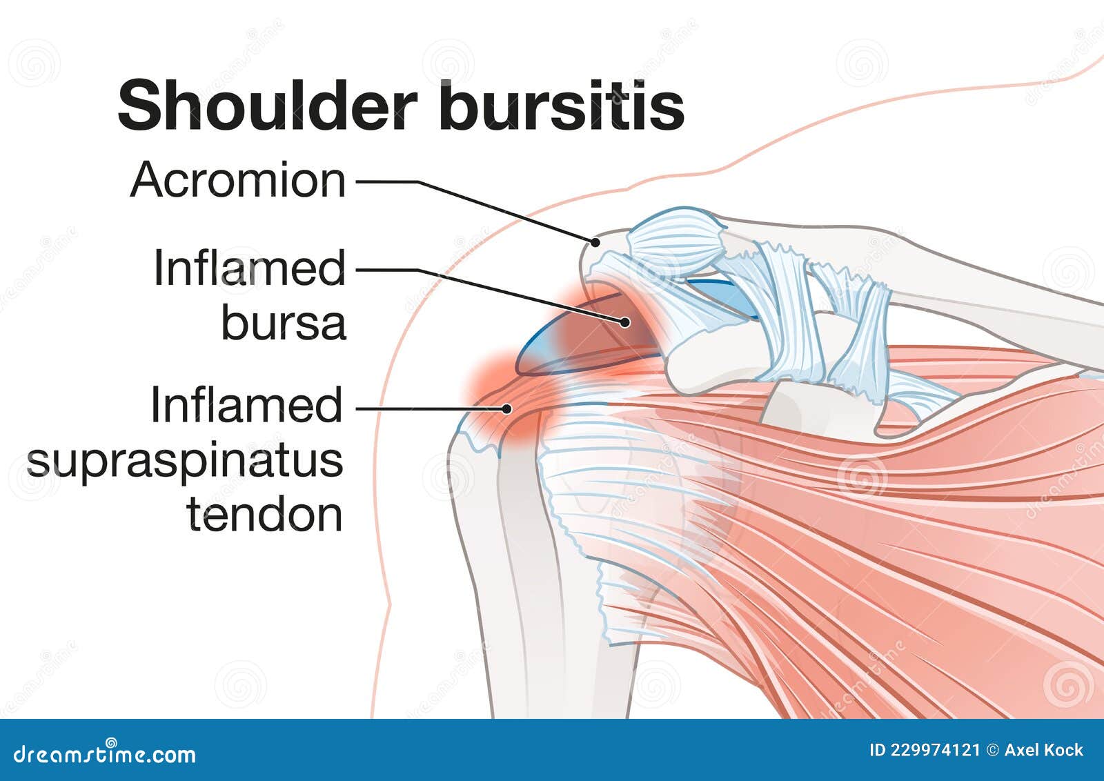 Shoulder Pain Bursa Sac