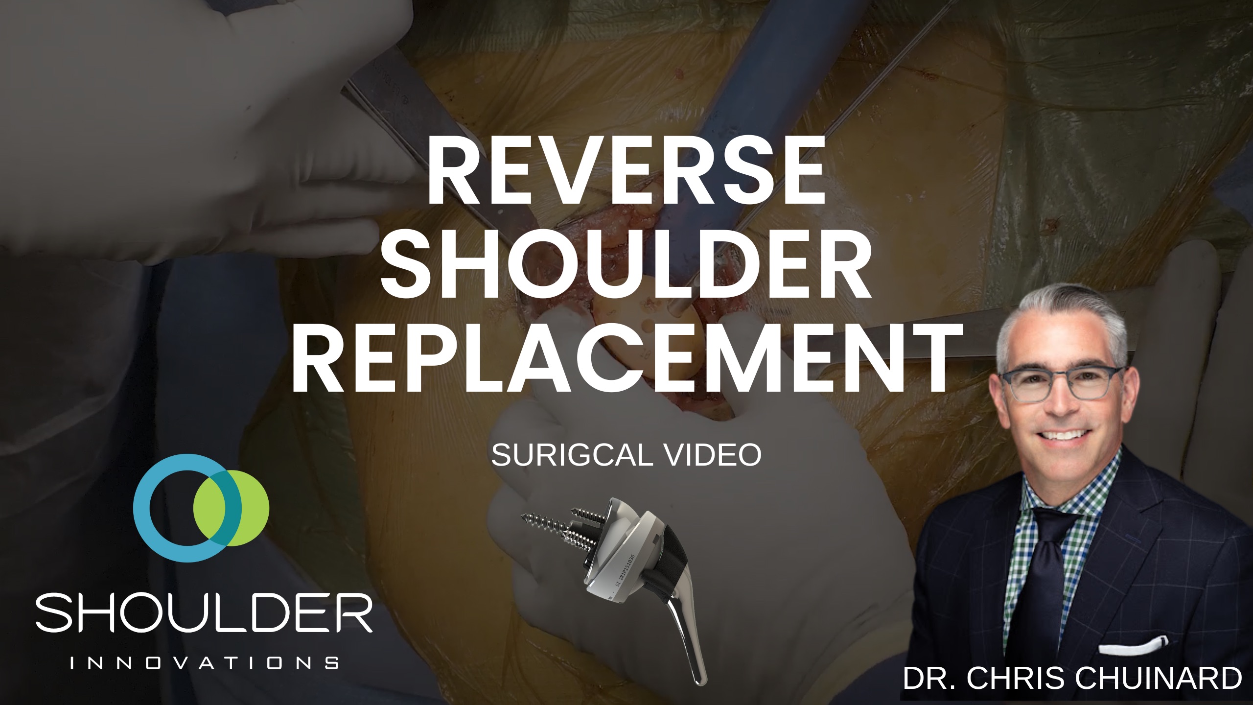 Shoulder Replacement Surgery Video