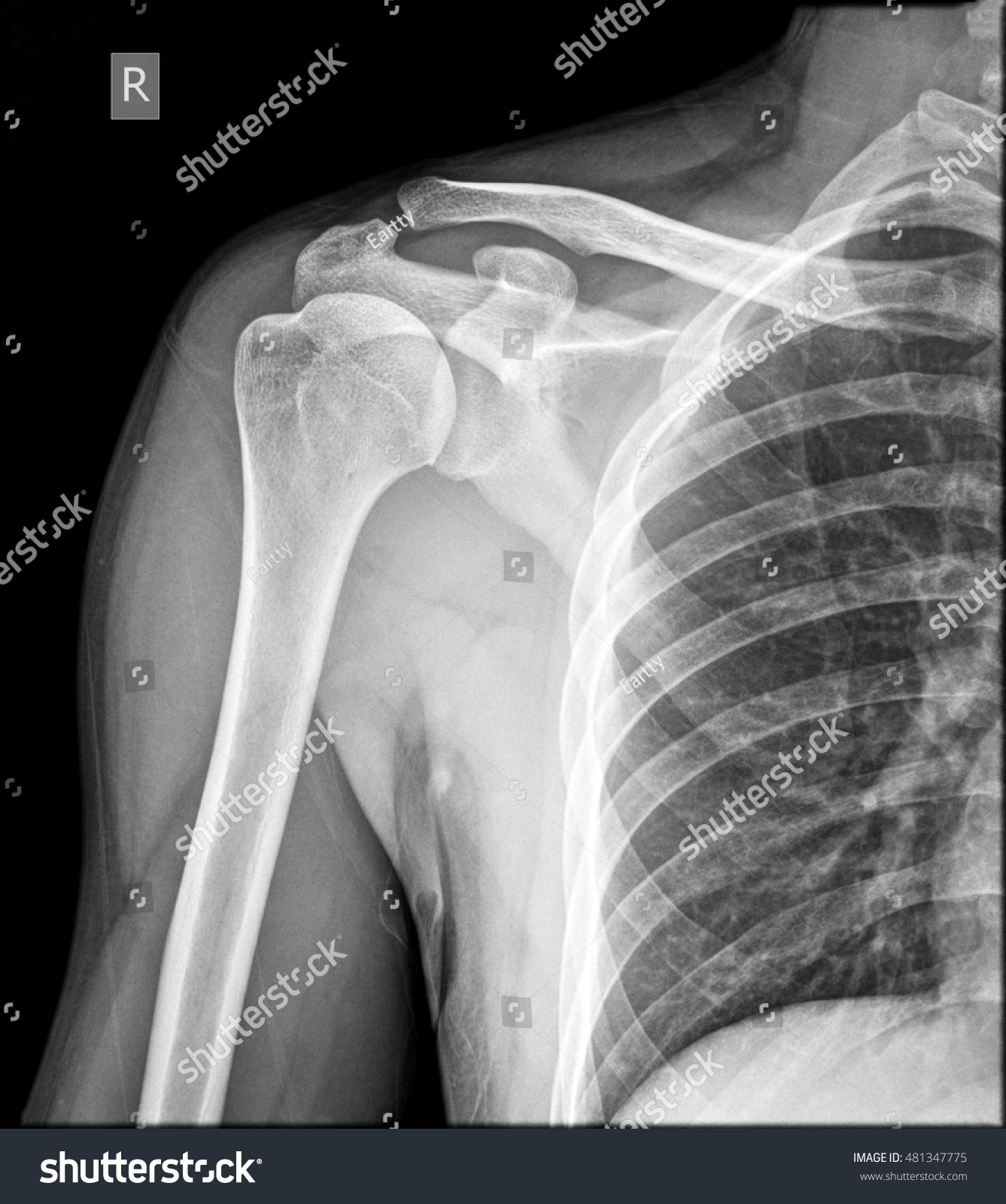Shoulder X Ray