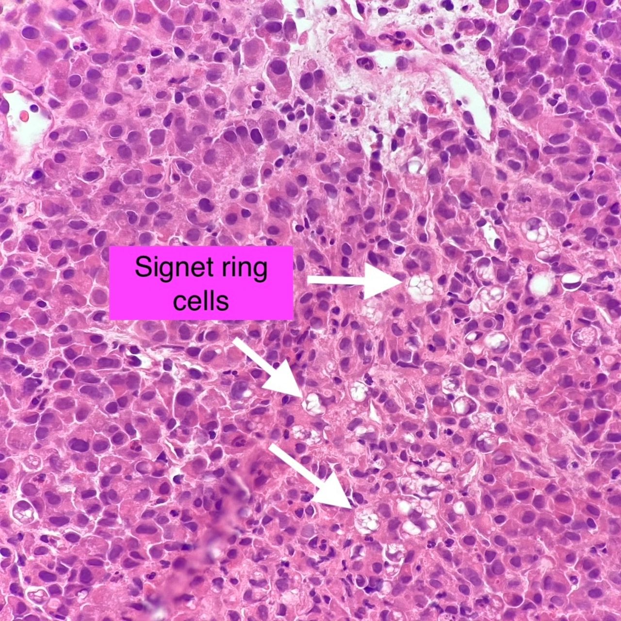 Signet Ring Cell Adenocarcinoma