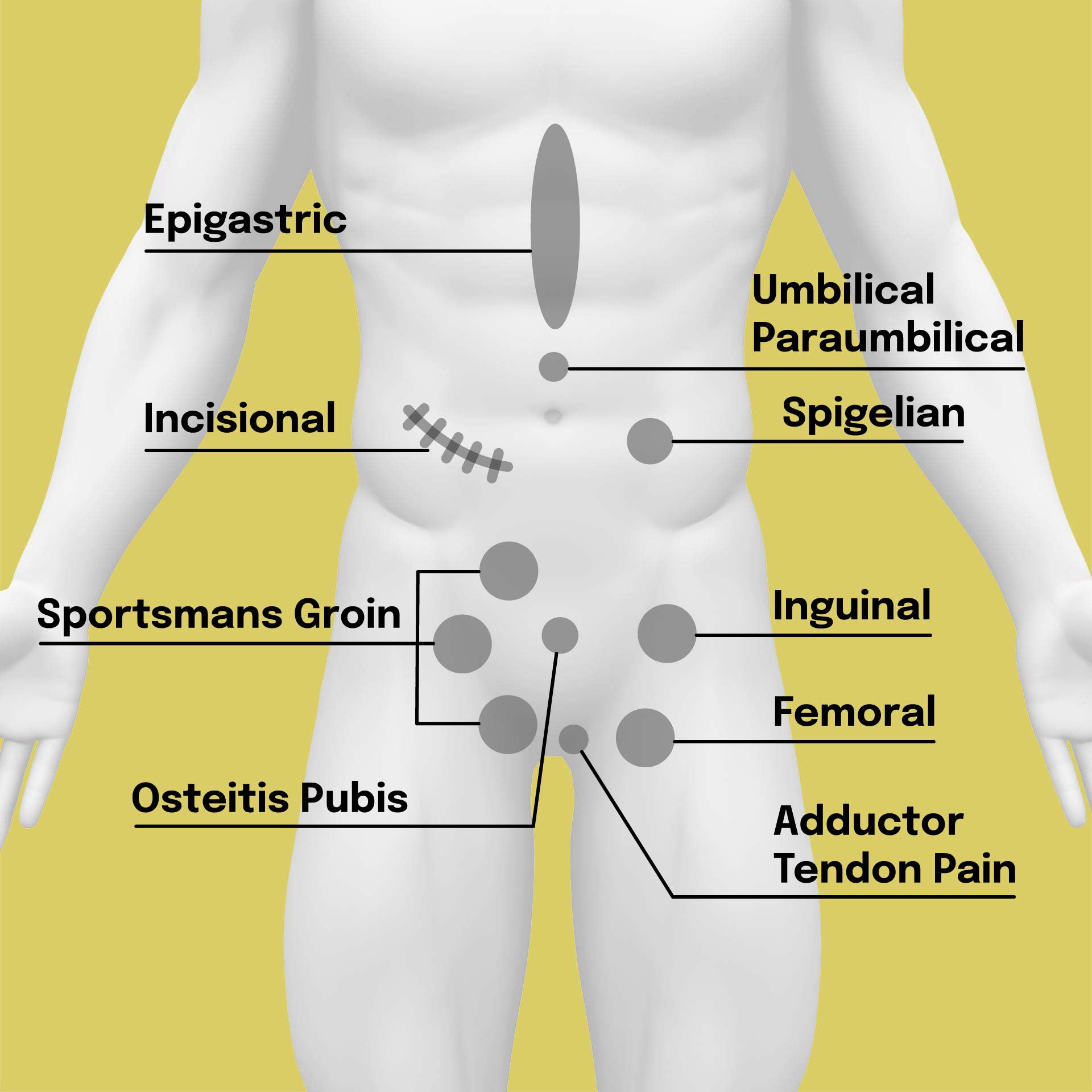 Signs Of A Hernia Groin