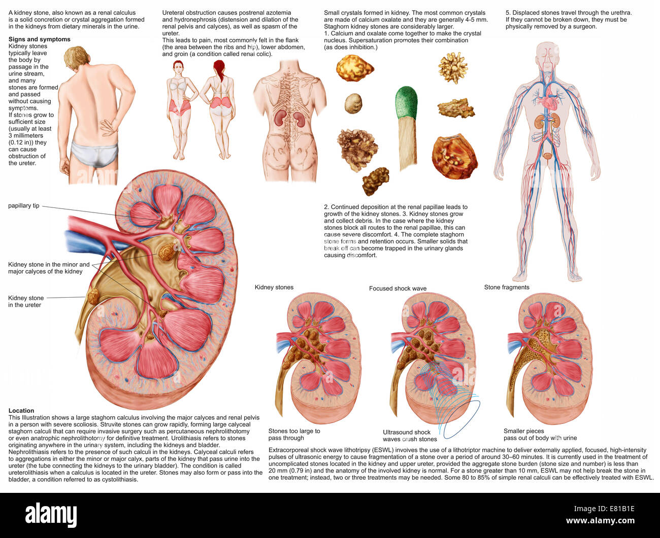 Signs Of A Kidney Stone