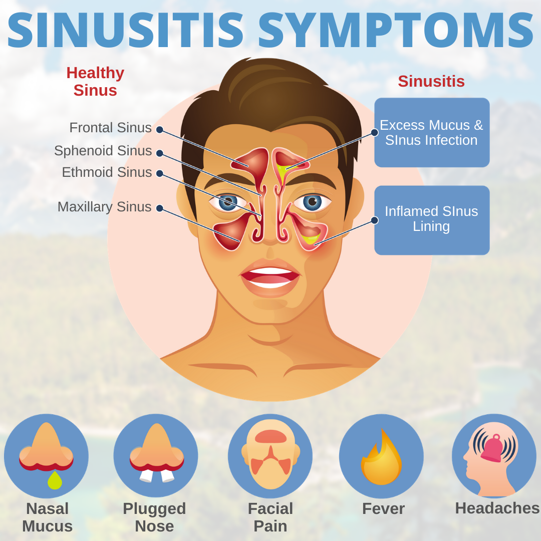 Signs Of A Sinus Infection