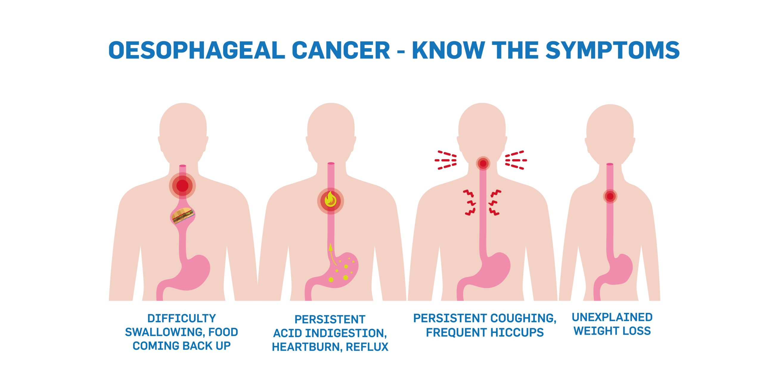 Signs Of Esophageal Cancer