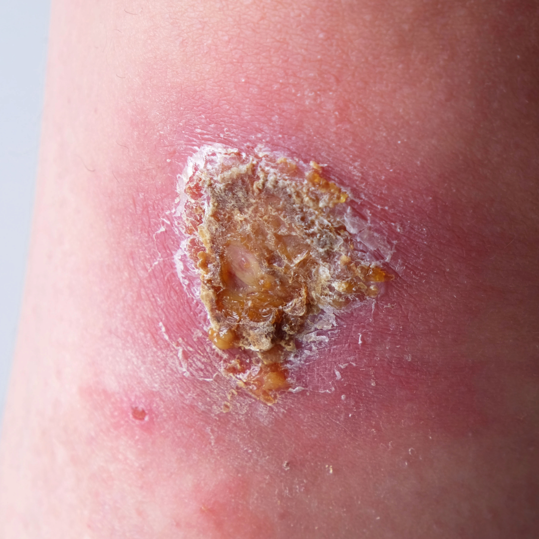 Signs Of Infected Wound