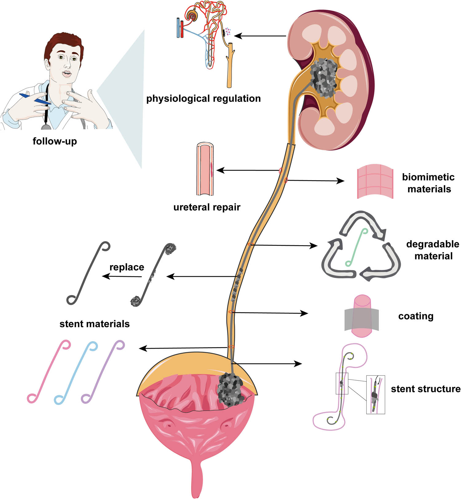 Signs Of Ureteral Stent Infection