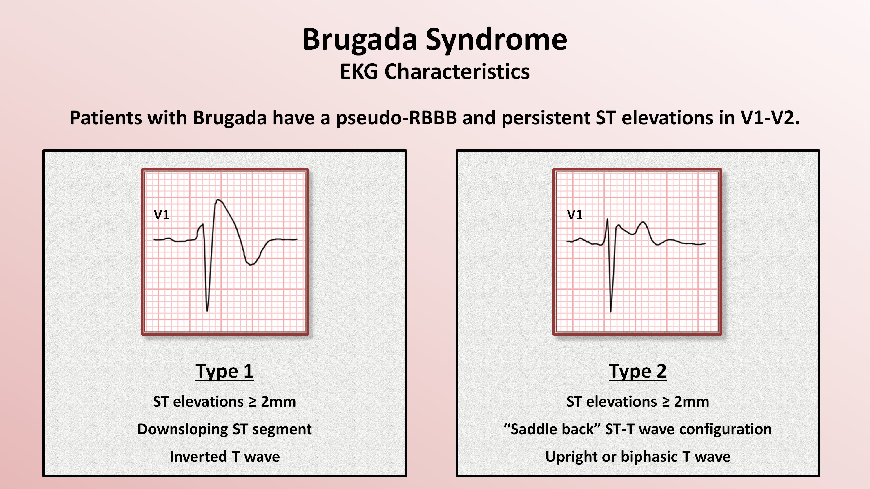Sindrome Brugada Ecg