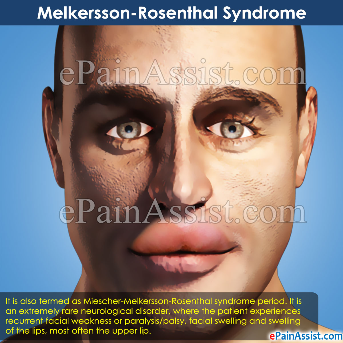 Sindrome Melkersson Rosenthal