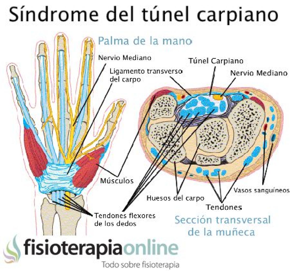 Sindrome Tunel Carpiano