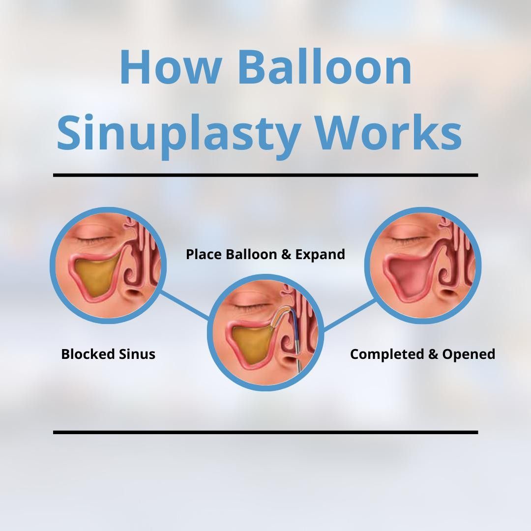Sinus Balloon Surgery