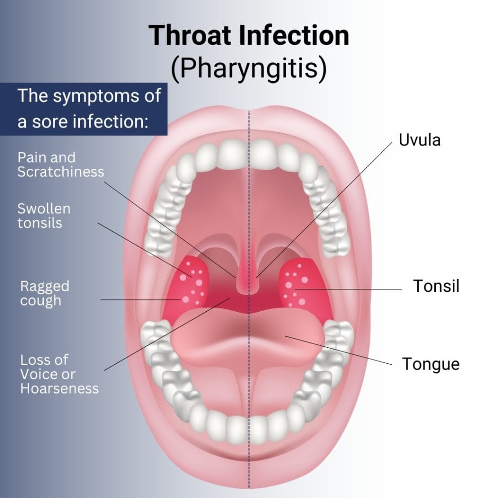 Sinus Infection Sore Throat