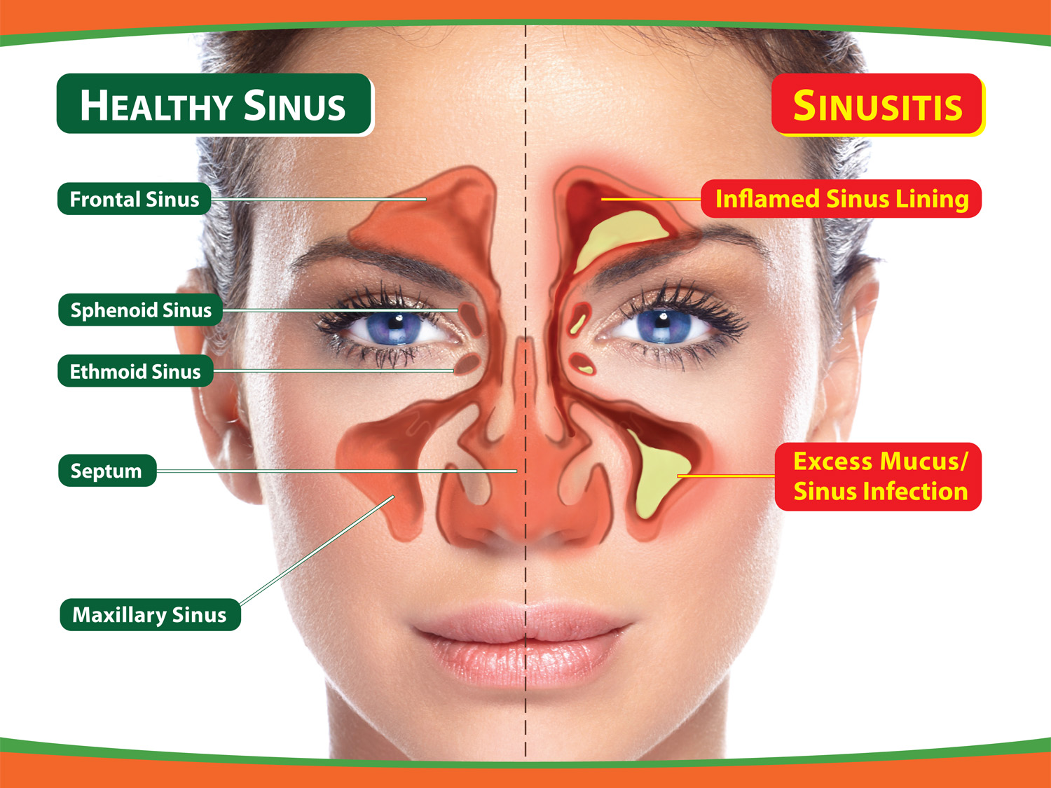 Sinus Infection Without Congestion