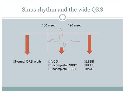 Sinus Rhythm With Wide Qrs