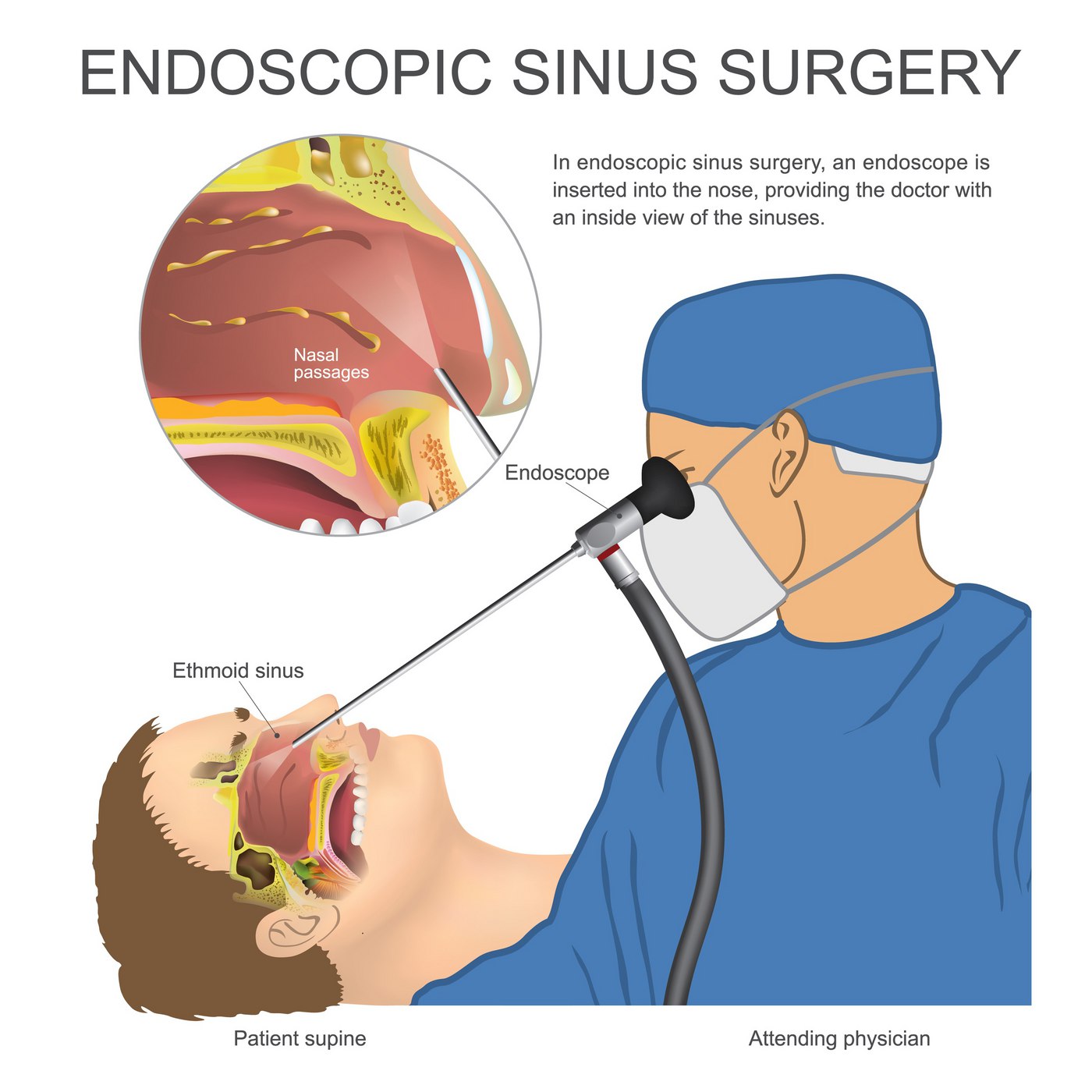 Sinus Surgery Types