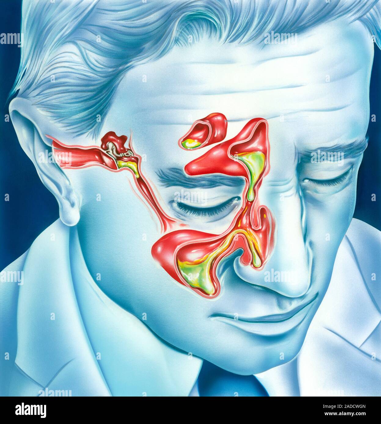 Sinuses And Ears Hurt