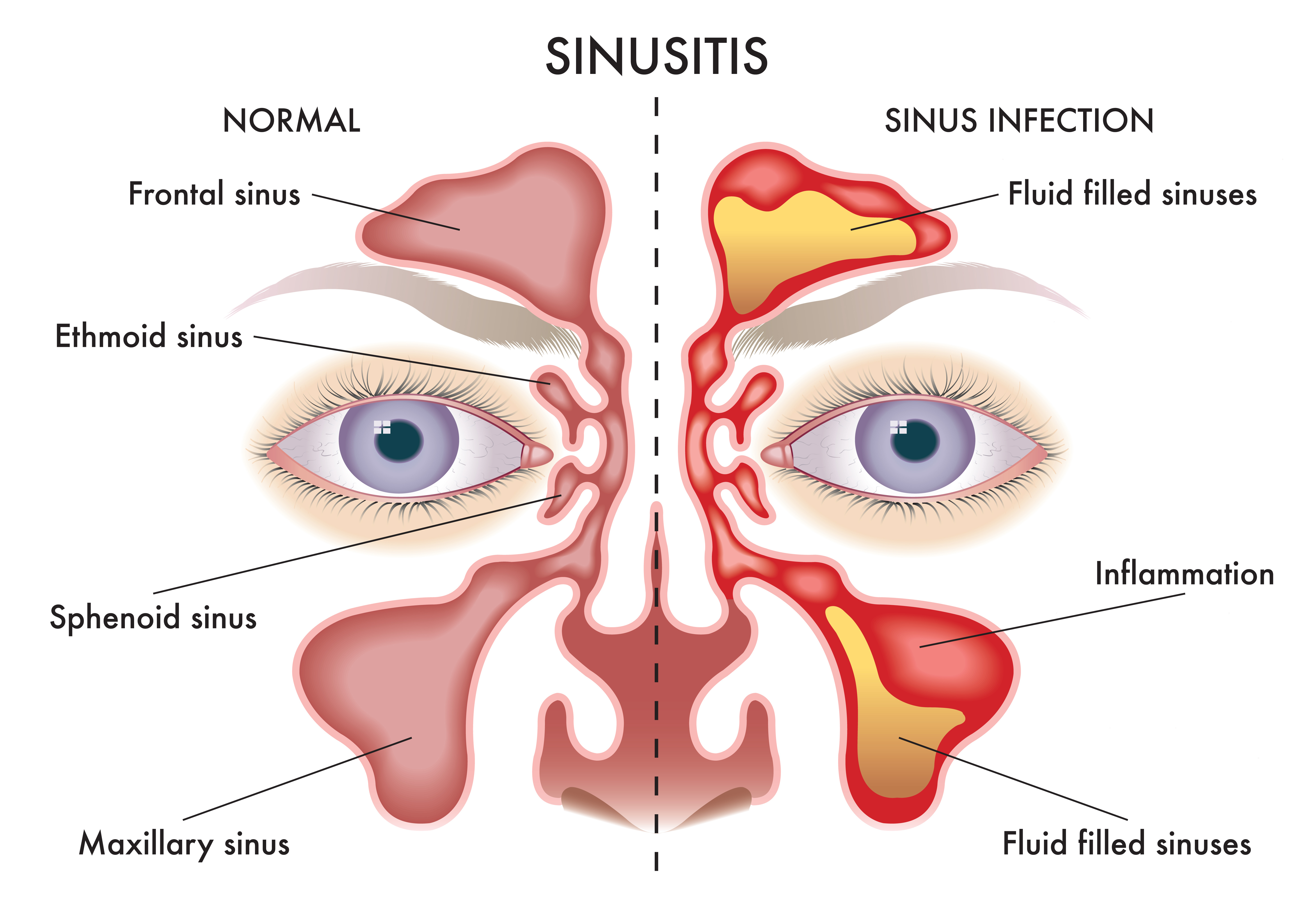 Sinusitis Ear Blockage