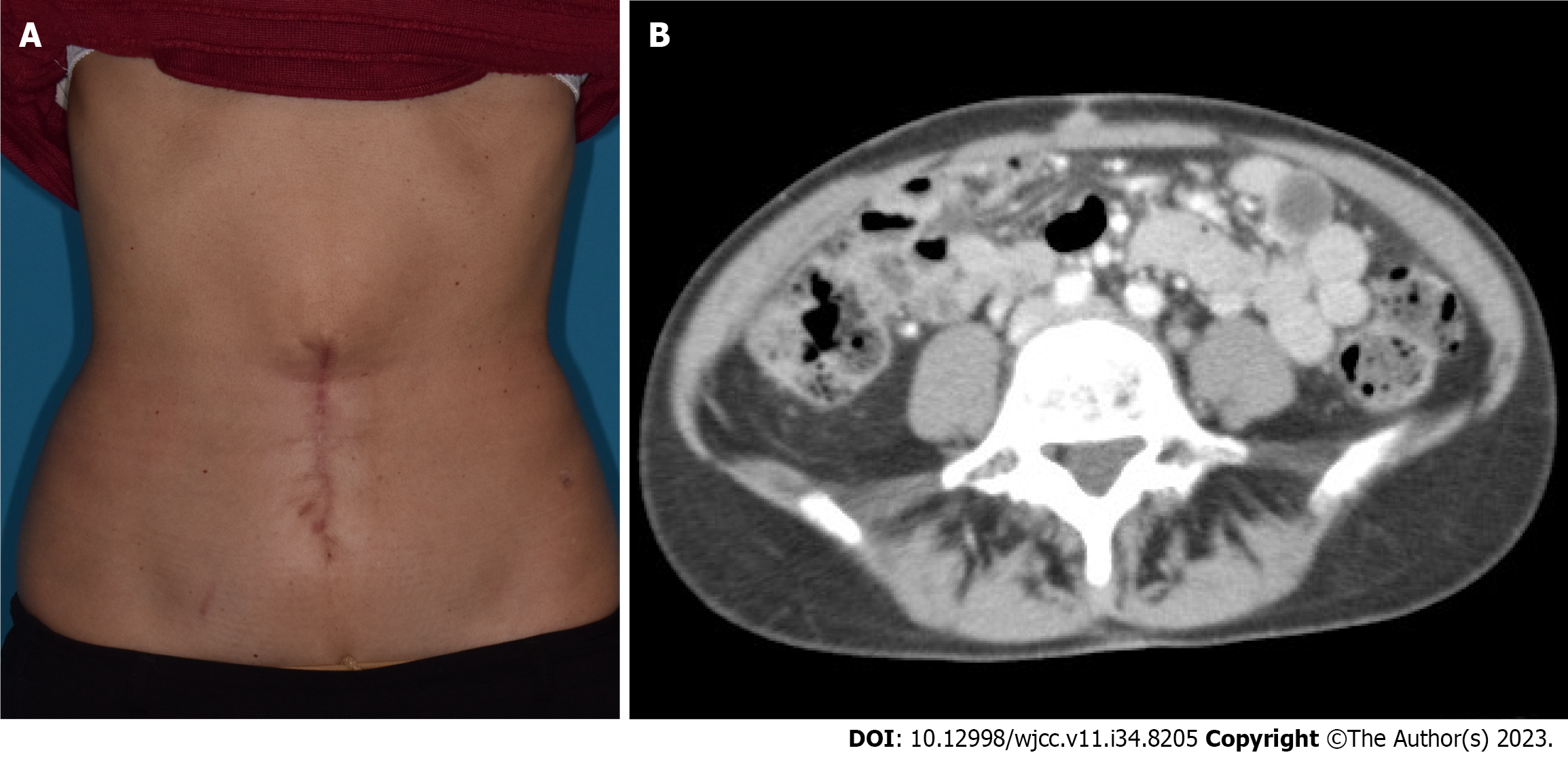 Sister Mary Joseph Nodule