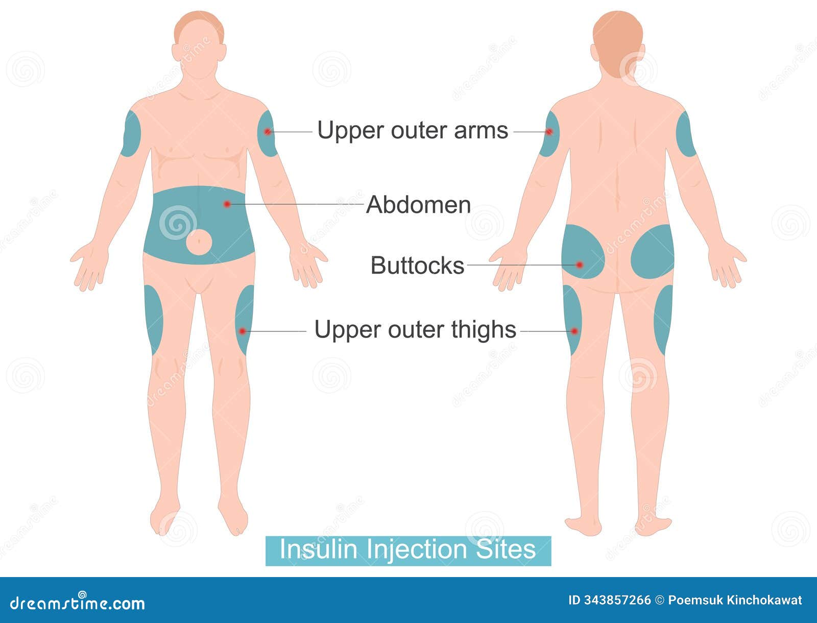 Sites For Injecting Insulin