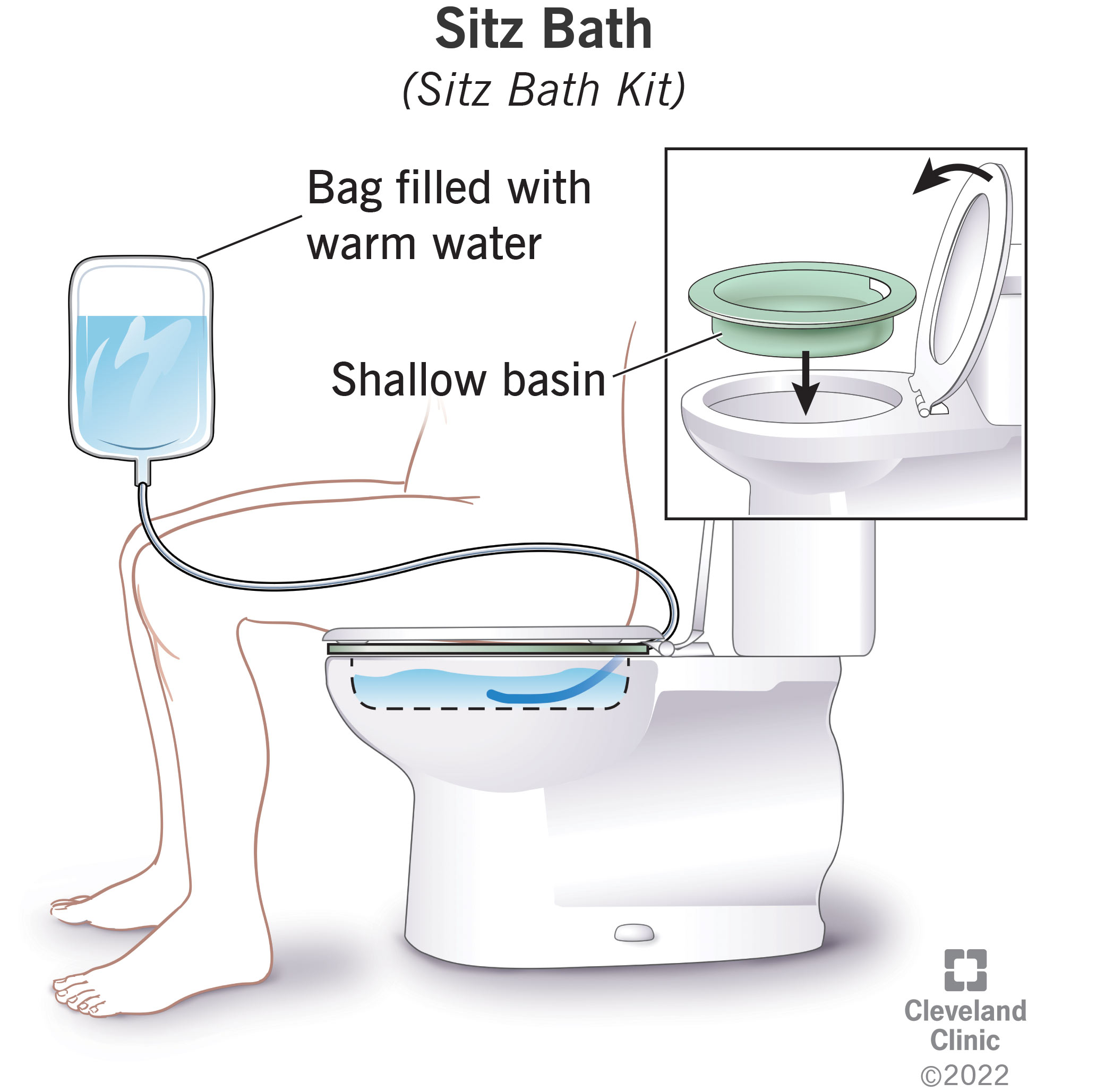 Sitz Bath For Bartholin Cyst
