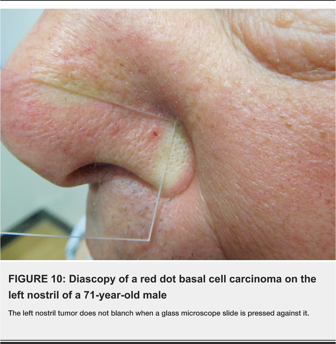 Skin Cancer Inside Nose