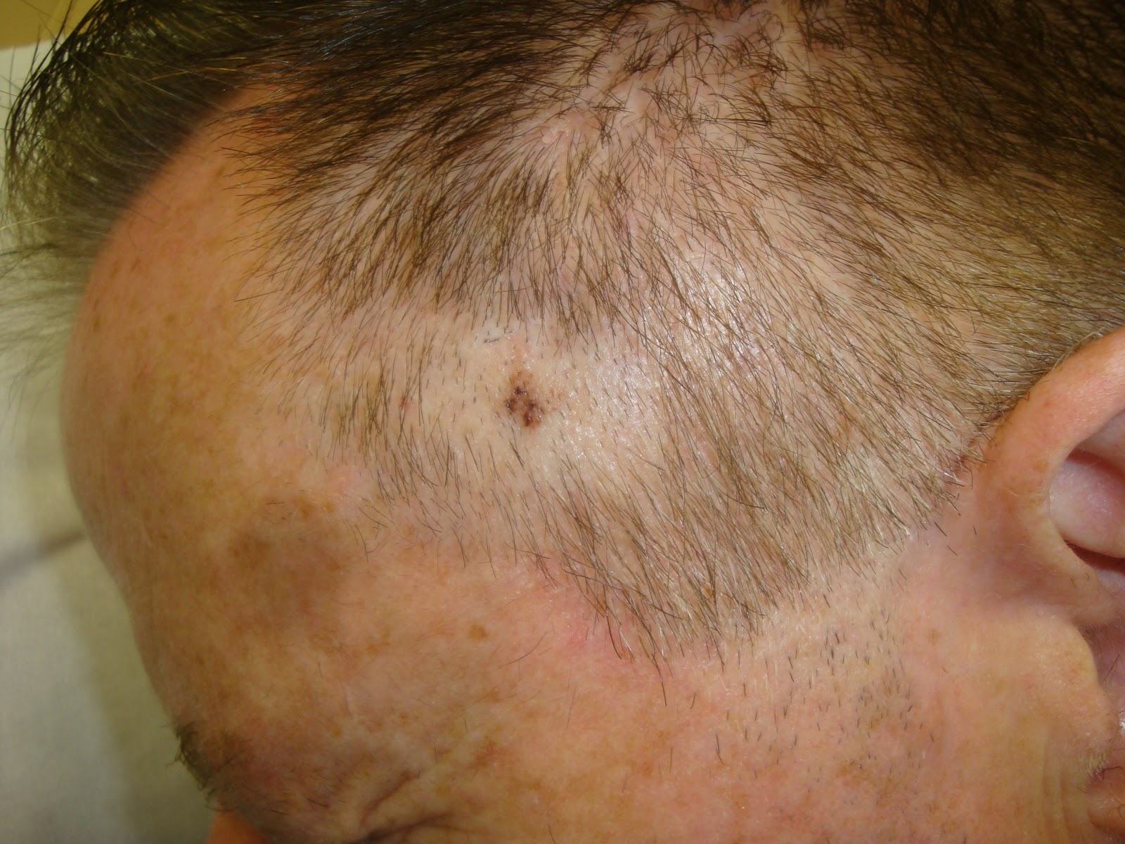 Skin Cancer On Scalp