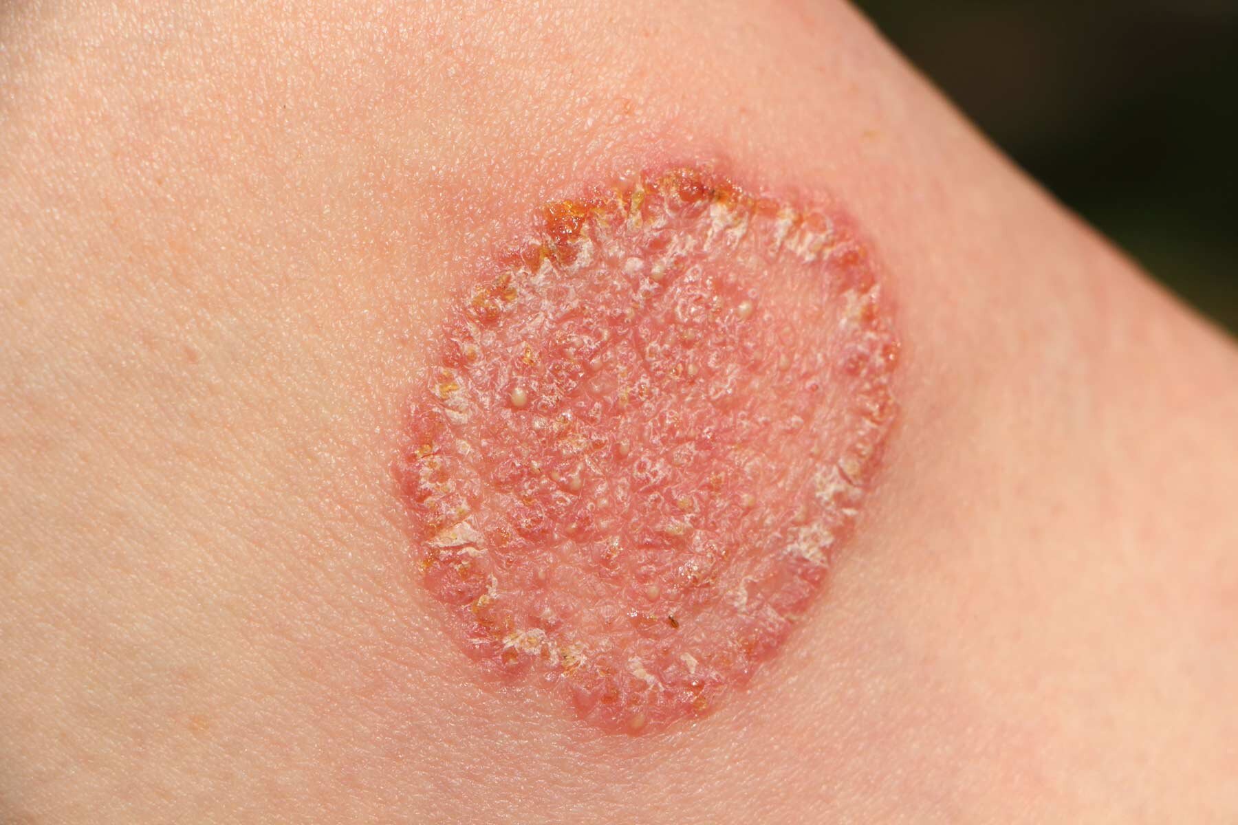 Skin Fungal Infection