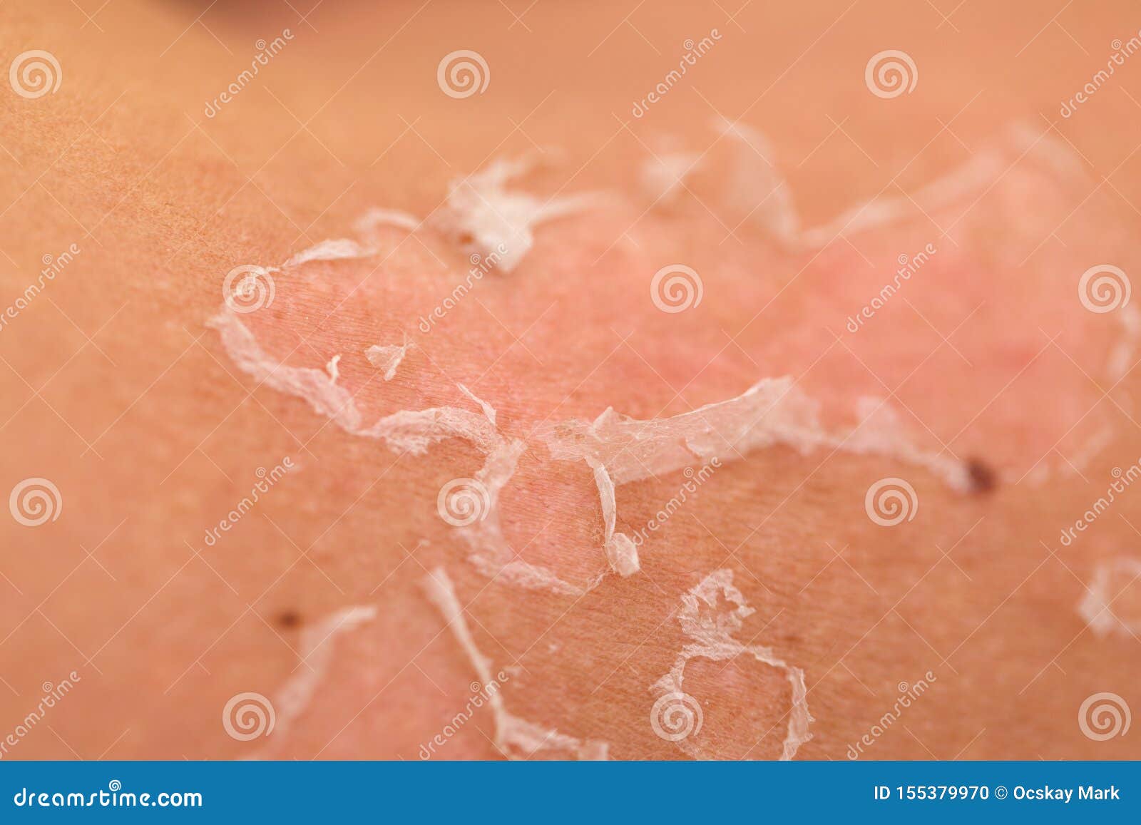 Skin Peeling After Sunburn