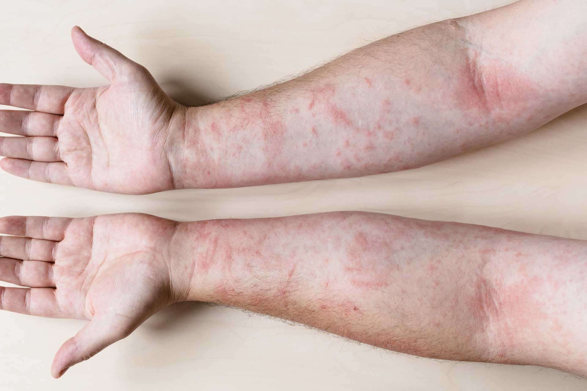 Skin Rash Hives Causes