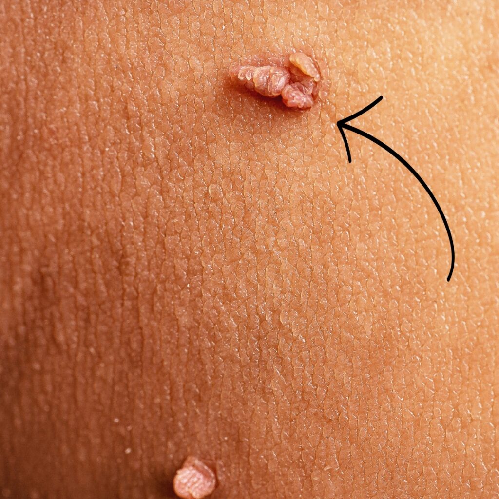 Skin Tag On Nipple
