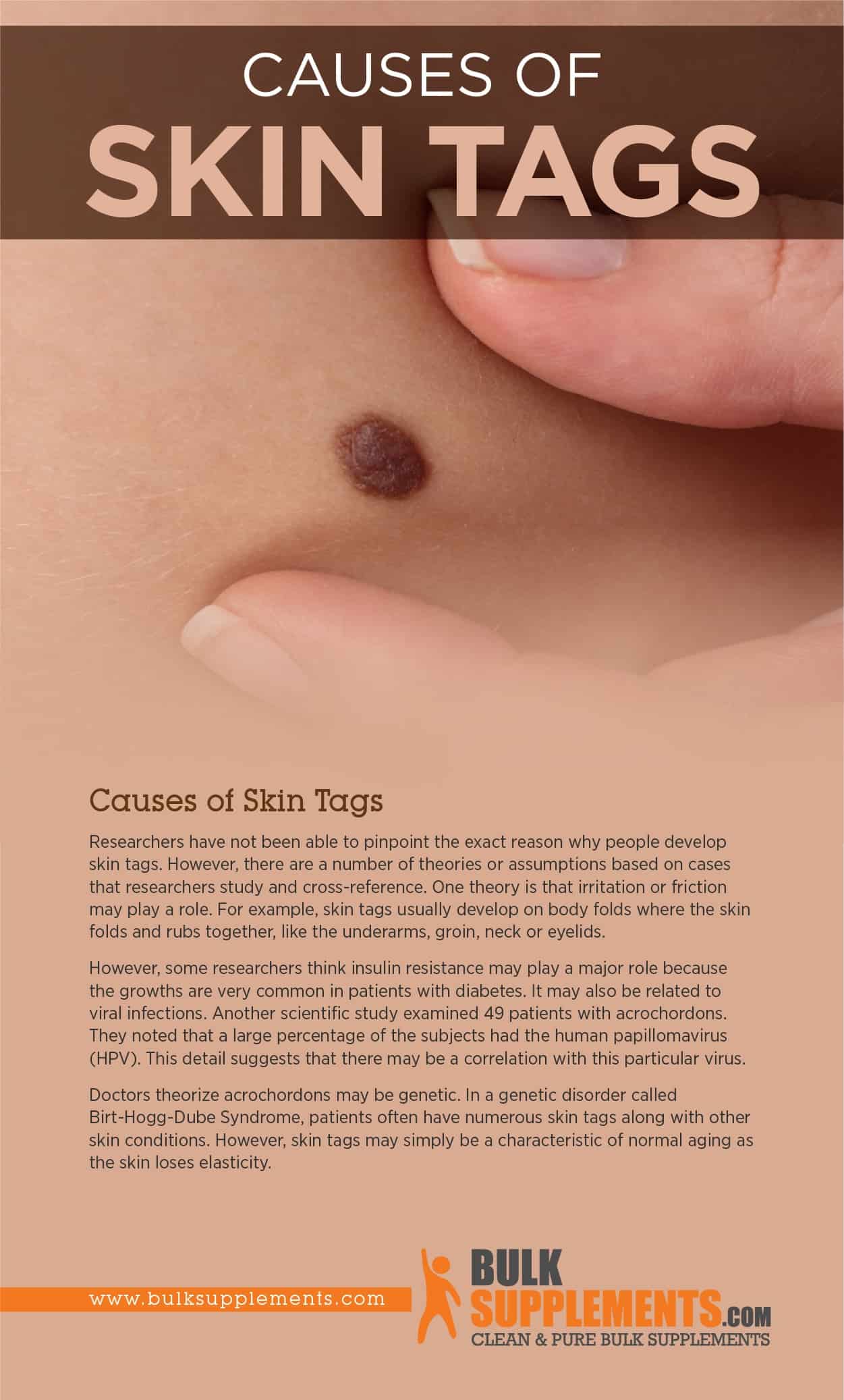 Skin Tags Causes