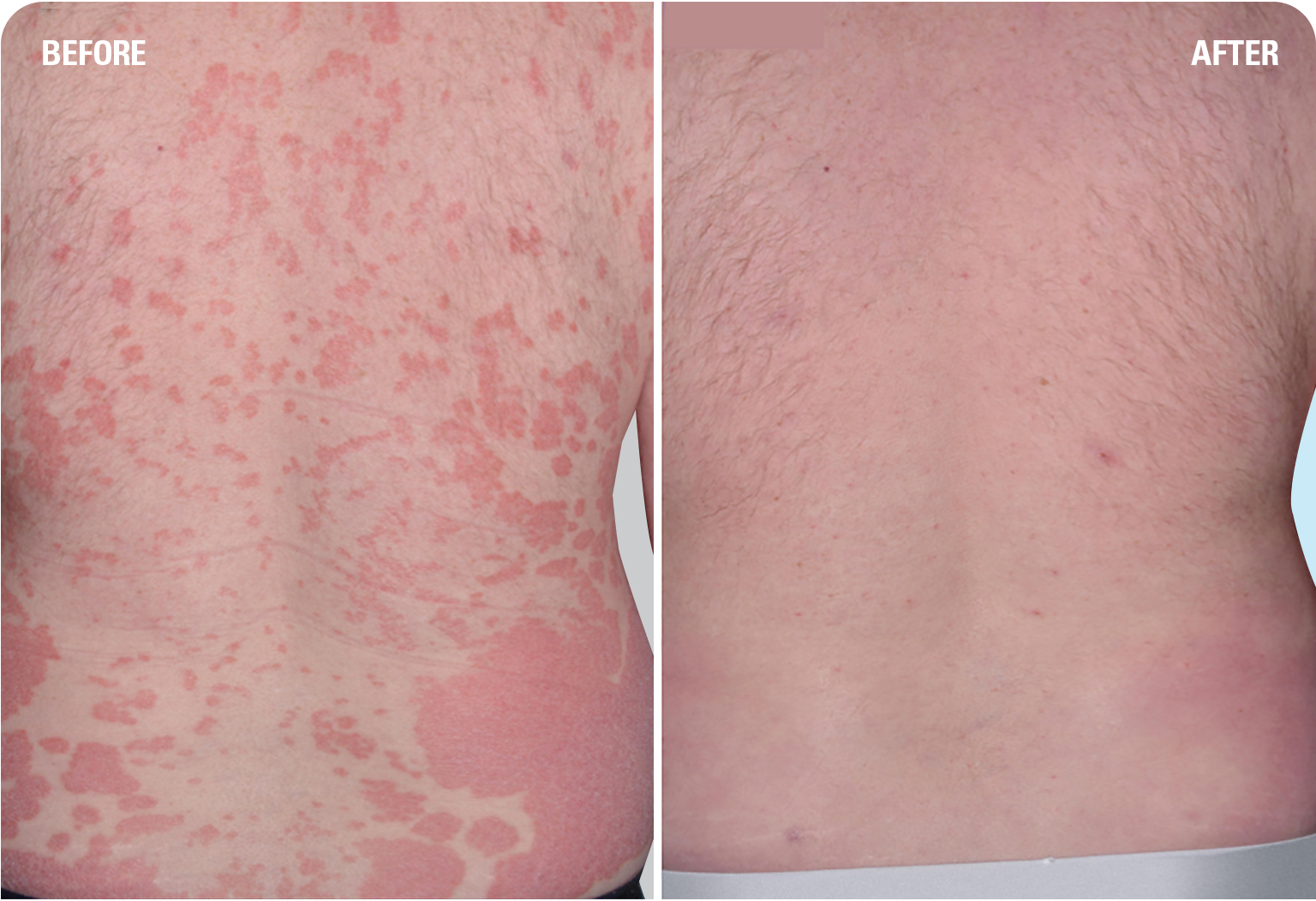 Skyrizi Side Effects