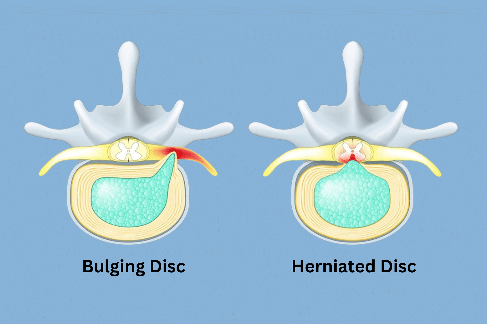 Slipped Disk Vs Herniated Disk