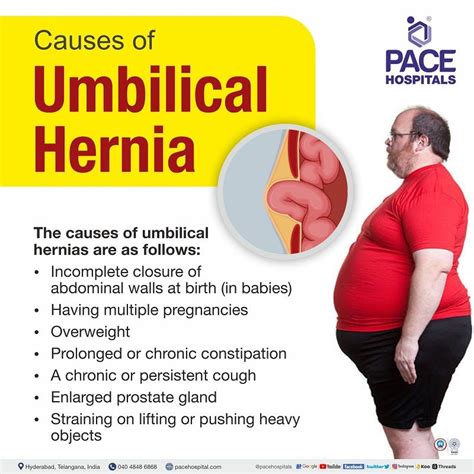 Small Fat Containing Umbilical Hernia